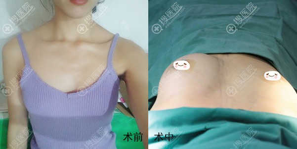 先天条件不足选择口碑不错的长沙艺星做假体隆胸效果很nice