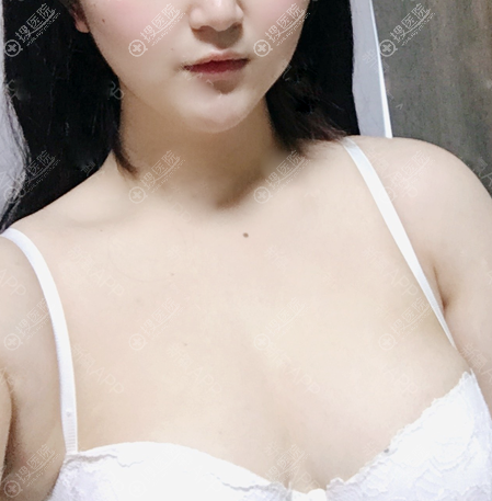 感觉找西安画美罗曼做完假体隆胸15天左右手感就很真实很自然了