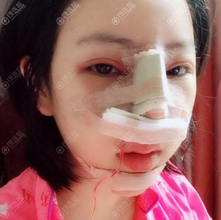 贵阳美莱鼻综合隆鼻术后恢复过程图 贵阳美莱鼻综合隆鼻术后恢复过程图