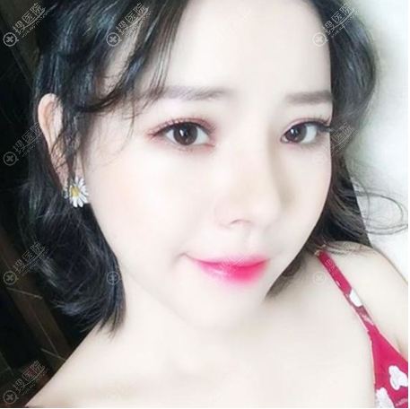 贵阳美莱刘照医生做的鼻综合隆鼻案例 贵阳美莱刘照医生做的鼻综合隆鼻案例