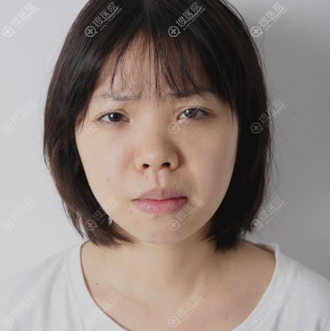 其实去贵阳美莱找刘照做肋软骨鼻综合隆鼻前我还考虑过贵阳华美