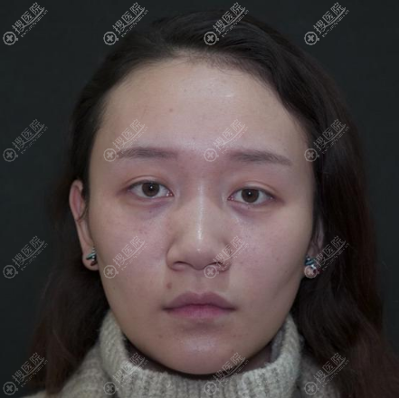 不得不说这次选择贵阳华美谢占军做的眼鼻脂肪填充还是很成功的
