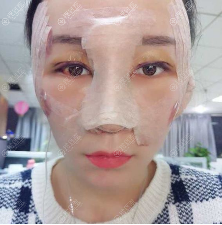 贵阳华美双眼皮隆鼻脂肪填充术后效果 贵阳华美双眼皮隆鼻脂肪填充术后效果