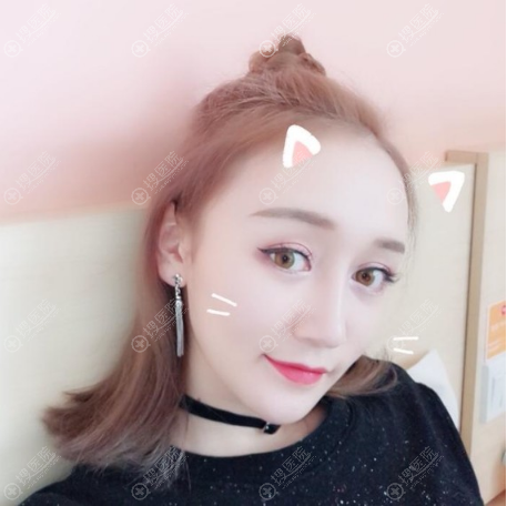 贵阳华美谢占军做的双眼皮隆鼻脂肪填充案例 贵阳华美谢占军做的双眼皮隆鼻脂肪填充案例