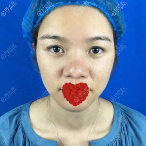 到沧州华美做硅胶隆鼻1个月恢复效果,侧面真的太喜欢了
