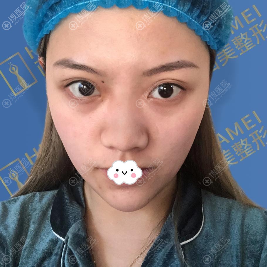 广州画美隆鼻多少钱?1W价格找张勇做硅胶假体隆鼻综合整形值吗