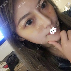 广东画美张勇隆鼻术后真实恢复效果 广东画美张勇隆鼻术后真实恢复效果