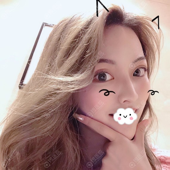 广东画美隆鼻怎么样?张勇鼻综合案例恢复图 广东画美隆鼻怎么样?张勇鼻综合案例恢复图