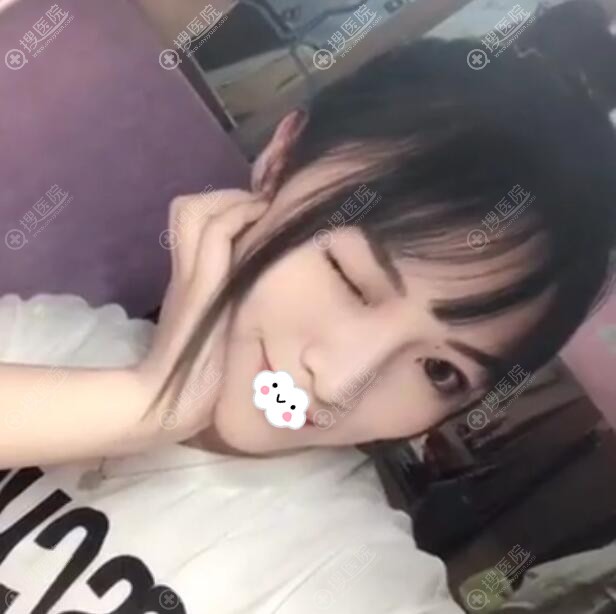 <!--<i data=20240710 data-id=11950></i>-->张勇假体隆鼻综合整形恢复效果图 <!--<i data=20240710 data-id=11950></i>-->张勇假体隆鼻综合整形恢复效果图