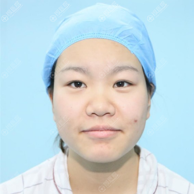 好不容易才预约到上海美莱卢建医生在周六给我做双眼皮隆鼻手术