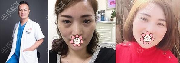 长沙雅美刘志刚全面部脂肪填充案例 长沙雅美刘志刚全面部脂肪填充案例