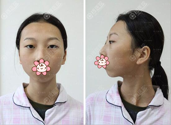 成都军大整形美容医院双眼皮+垫下巴手术成就凸嘴少女的逆袭