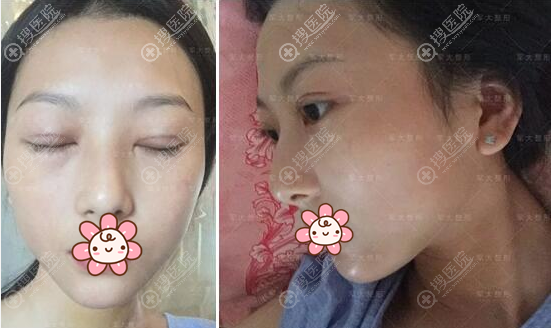 双眼皮垫下巴手术术后半个月 双眼皮垫下巴手术术后半个月