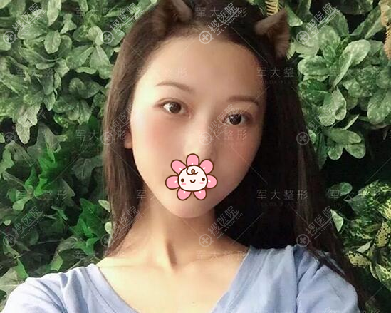 <!--<i data=20240710 data-id=15150></i>-->整形垫下巴术后效果图 <!--<i data=20240710 data-id=15150></i>-->整形垫下巴术后效果图