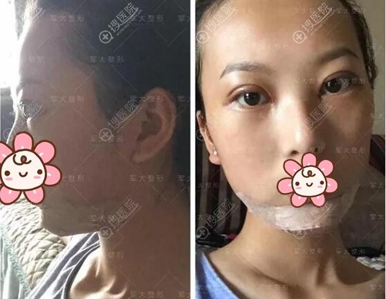 垫下巴手术后正脸侧脸照片 垫下巴手术后正脸侧脸照片