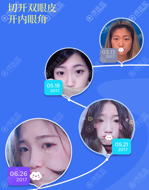 运城丽都整形医院双眼皮开眼角案例恢复过程 运城丽都整形医院双眼皮开眼角案例恢复过程