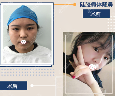 运城丽都贾盛斌鼻综合案例 运城丽都贾盛斌鼻综合案例