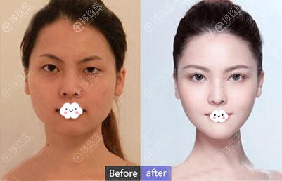 运城华美陈先才双眼皮案例 运城华美陈先才双眼皮案例