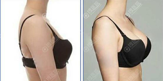 运城华美假体隆胸真人案例 运城华美假体隆胸真人案例