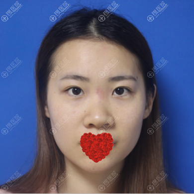 鼻综合手术三个月有了韩国女神的气质,很幸运选择常德伊丽莎白