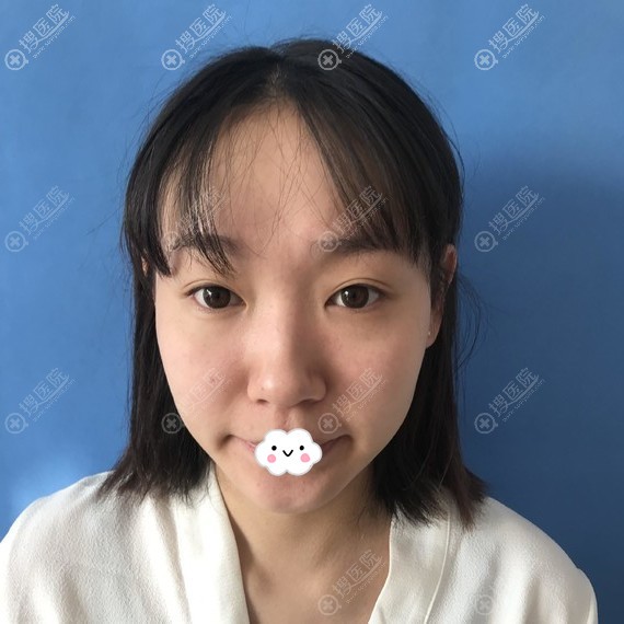 找正规医院泰州丽都李丽杰2W价格做假体隆鼻综合整形案例恢复图