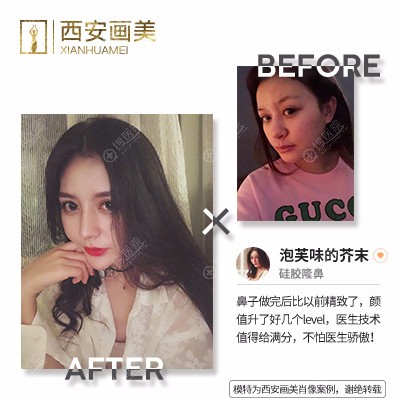 西安画美罗曼假体隆鼻案例 西安画美罗曼假体隆鼻案例