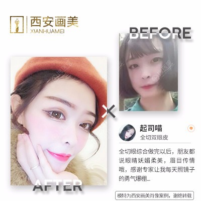西安画美罗金刚双眼皮案例 西安画美罗金刚双眼皮案例