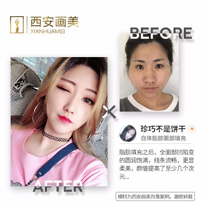 西安画美张新成自体脂肪面部填充案例 西安画美张新成自体脂肪面部填充案例