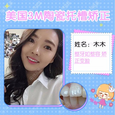 西安画美<!--<i data=20240710 data-id=15923></i>-->做的牙齿矫正案例 西安画美<!--<i data=20240710 data-id=15923></i>-->做的牙齿矫正案例