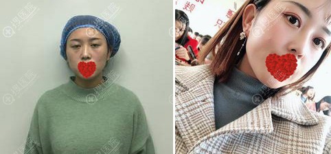 <!--<i data=20240710 data-id=11940></i>-->双眼皮术前术后对比效果 <!--<i data=20240710 data-id=11940></i>-->双眼皮术前术后对比效果