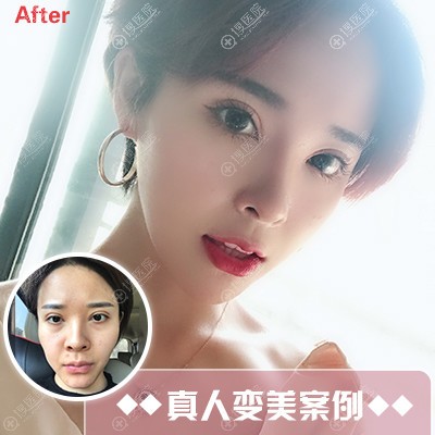 <!--<i data=20240710 data-id=12625></i>-->刘明飞做的隆鼻和脂肪填充案例 <!--<i data=20240710 data-id=12625></i>-->刘明飞做的隆鼻和脂肪填充案例