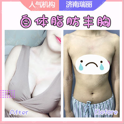 <!--<i data=20240710 data-id=12625></i>-->刘明飞做的自体脂肪隆胸案例 <!--<i data=20240710 data-id=12625></i>-->刘明飞做的自体脂肪隆胸案例