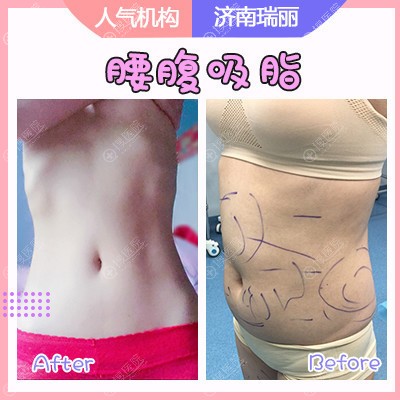 <!--<i data=20240710 data-id=12625></i>-->刘明飞医生吸脂案例 <!--<i data=20240710 data-id=12625></i>-->刘明飞医生吸脂案例