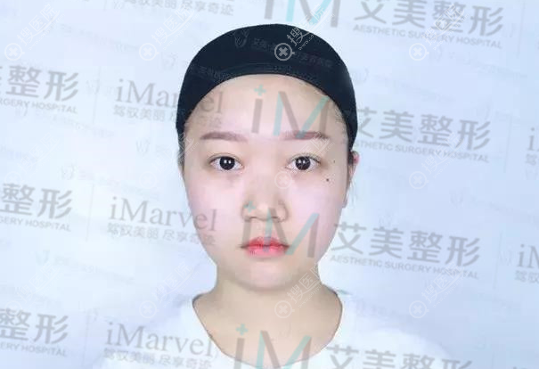 南阳艾美整形医院隆鼻案例术前照片 南阳艾美整形医院隆鼻案例术前照片