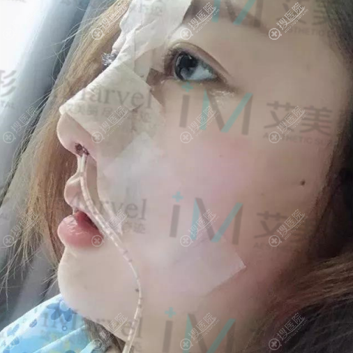 南阳艾美整形医院隆鼻手术效果图 南阳艾美整形医院隆鼻手术效果图