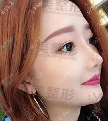 南阳艾美整形医院做隆鼻怎么样 南阳艾美整形医院做隆鼻怎么样