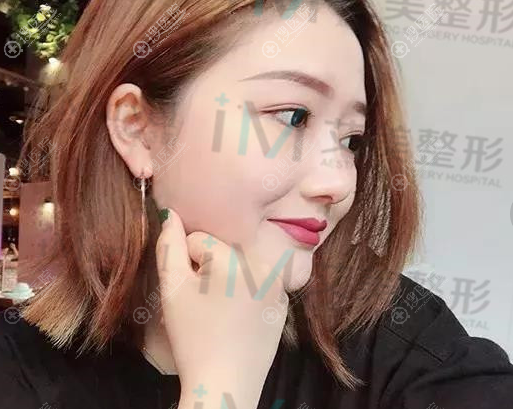南阳艾美陈保国院长隆鼻案例半个月效果图 南阳艾美陈保国院长隆鼻案例半个月效果图