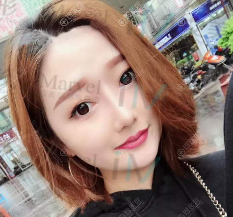 南阳艾美整形医院陈保国肋软骨隆鼻案例 南阳艾美整形医院陈保国肋软骨隆鼻案例