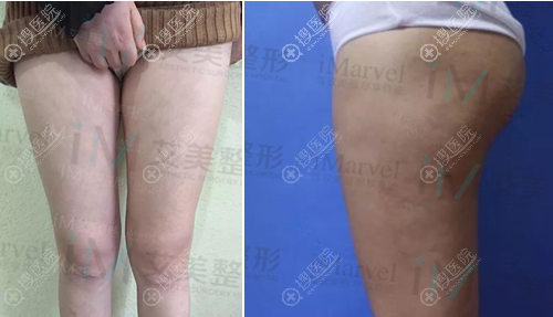 南阳艾美陈保国大腿环吸术后腿围由54cm变成49CM,赘肉也少了