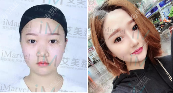 南阳艾美陈保国院长做的鼻综合隆鼻案例 南阳艾美陈保国院长做的鼻综合隆鼻案例