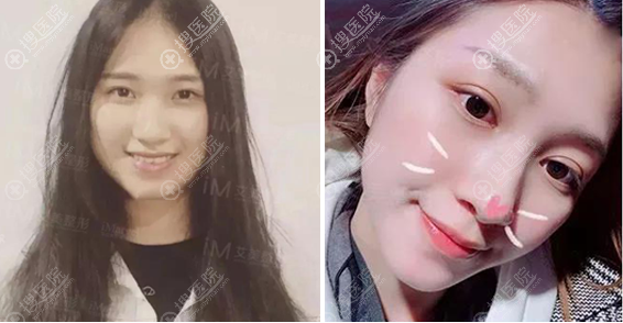 南阳艾美整形医院陈保国院长双眼皮案例 南阳艾美整形医院陈保国院长双眼皮案例