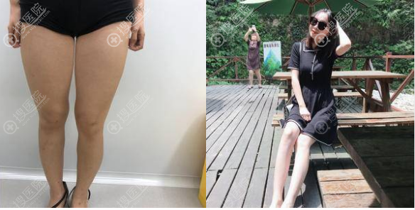 南阳艾美陈保国院长大腿吸脂案例 南阳艾美陈保国院长大腿吸脂案例