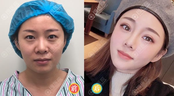 做完鼻综合和隆鼻哪个好的功课后才找北京悦然李京霖整鼻子的