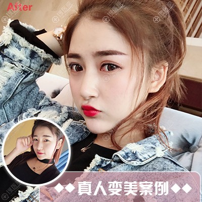 <!--<i data=20240710 data-id=12625></i>-->刘明飞做的双眼皮案例 <!--<i data=20240710 data-id=12625></i>-->刘明飞做的双眼皮案例