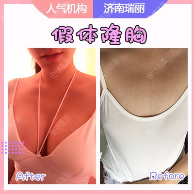<!--<i data=20240710 data-id=12625></i>-->张敬花做的隆胸案例 <!--<i data=20240710 data-id=12625></i>-->张敬花做的隆胸案例
