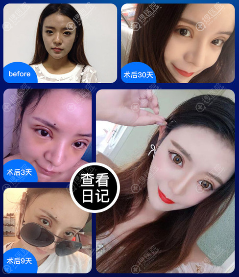 济南海峡谢燕燕做的双眼皮案例 济南海峡谢燕燕做的双眼皮案例