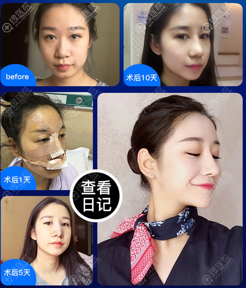 济南海峡李德庆做的肋软骨鼻综合隆鼻案例 济南海峡李德庆做的肋软骨鼻综合隆鼻案例