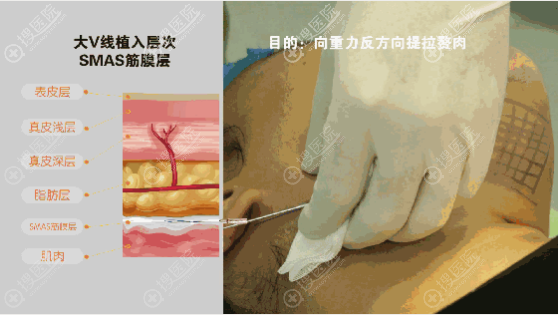 看成都军大线雕案例了解大V线雕跟小V线雕7大区别