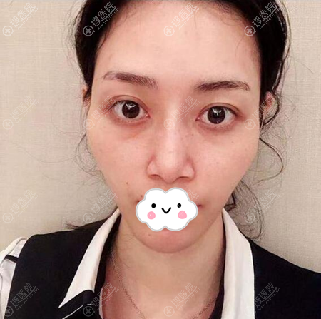 太阳穴凹陷怎么办?我面诊苏州美贝尔聂志宏后选自体脂肪填充