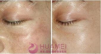 华美激光祛黄褐斑效果对比 华美激光祛黄褐斑效果对比